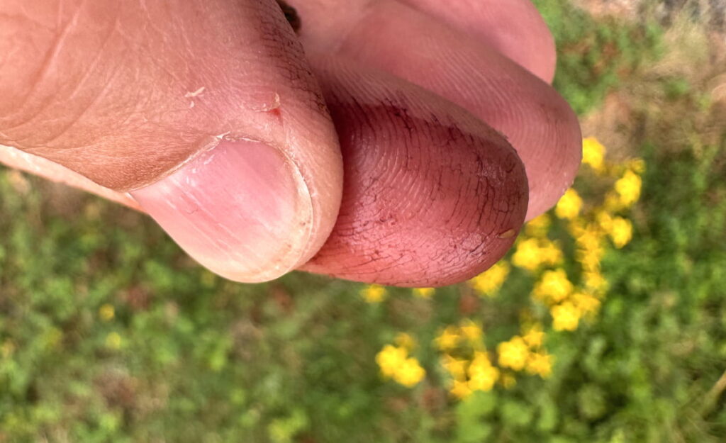 Index finger stained reddish purple by St. John's wort